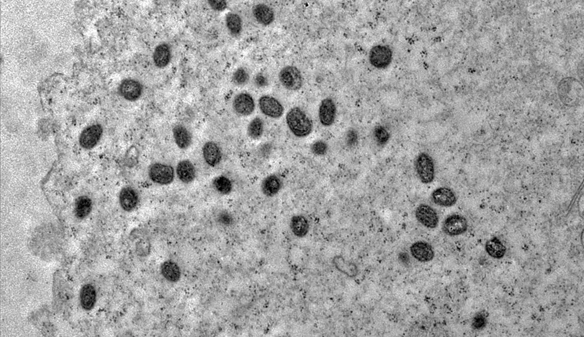 Brasil registra 136 casos de mpox em 2026; cinco estados notificam doença pela primeira vez no ano